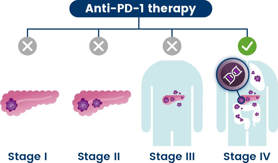adh1-pd-1 therapy stages on pancreas