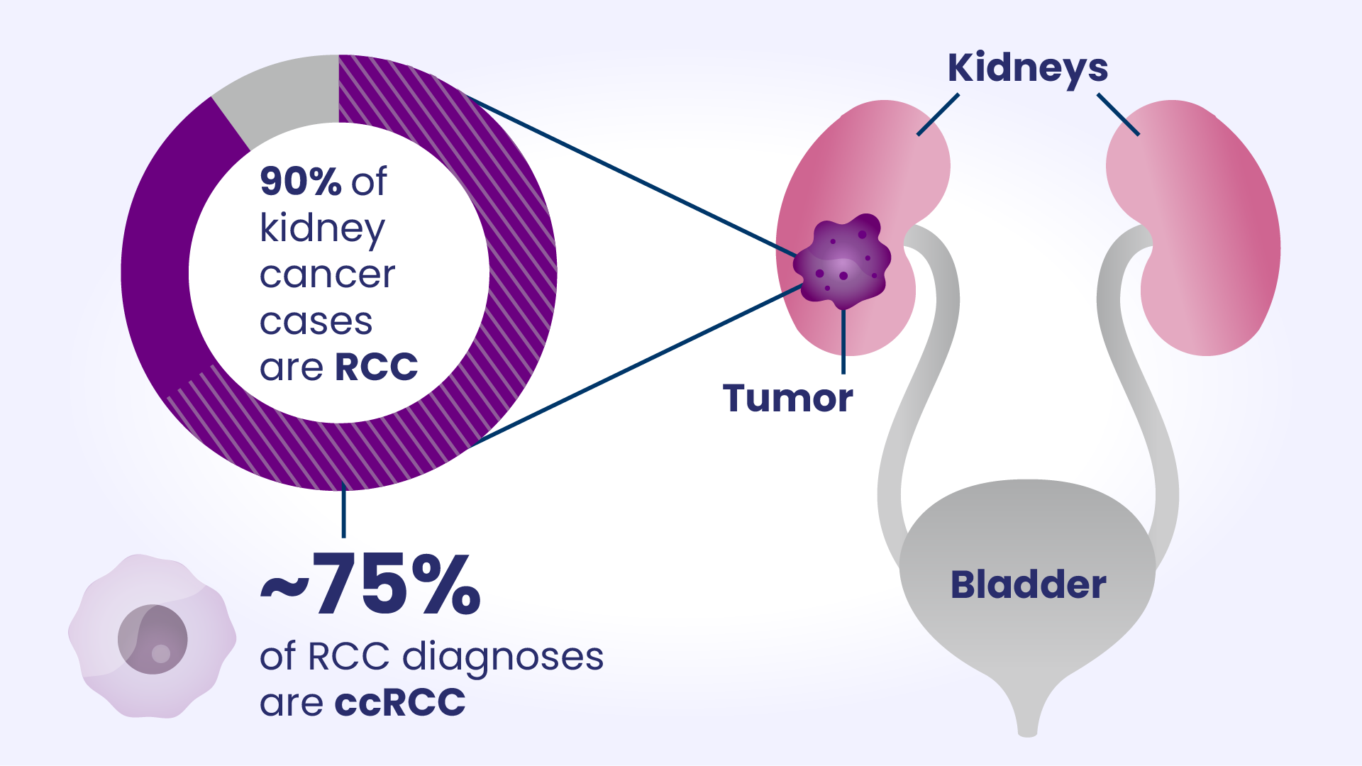 Kidney cancer illustration showing statistics on 90% of kidney cancer is RCC and 75% of RCC is ccRCC cancer